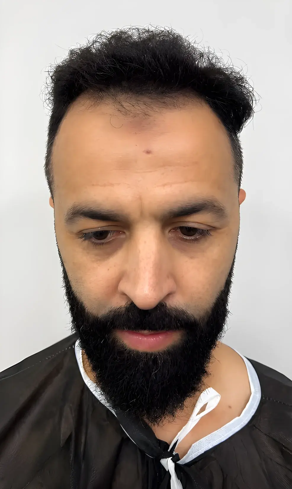 Vorher: Mann mit Bart und zurückweichender Haarlinie