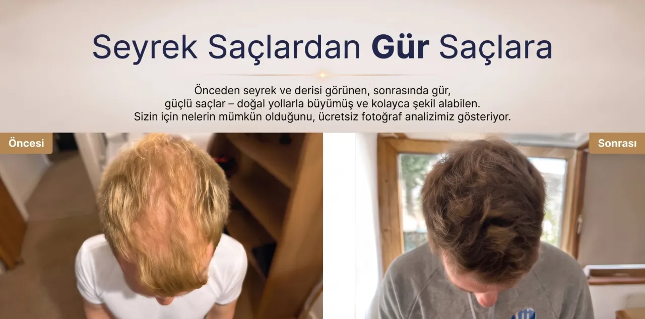 Öncesi ve sonrası: solda tepede seyrek saç, sağda saç ekimi sonrası sık saç